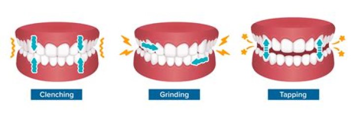 What can clenching your teeth cause?