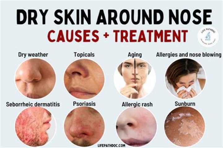 What causes sores on tip of nose?
