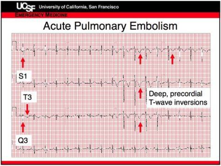 What does a PE look like on EKG?