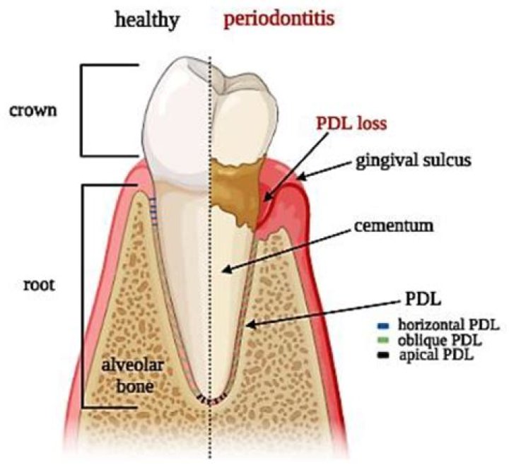 What does PDL mean in dentistry?