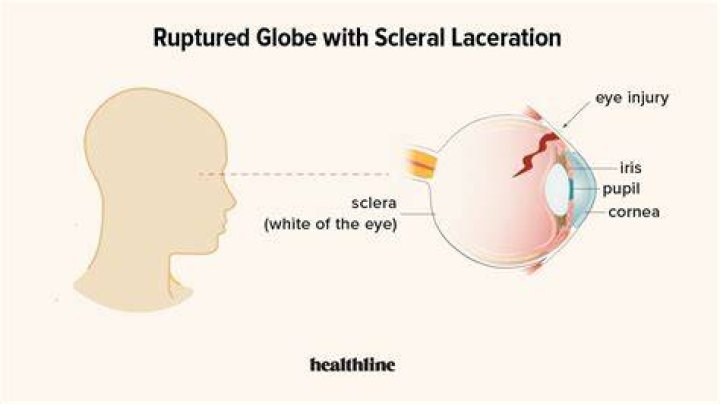What happens if the sclera is damaged?