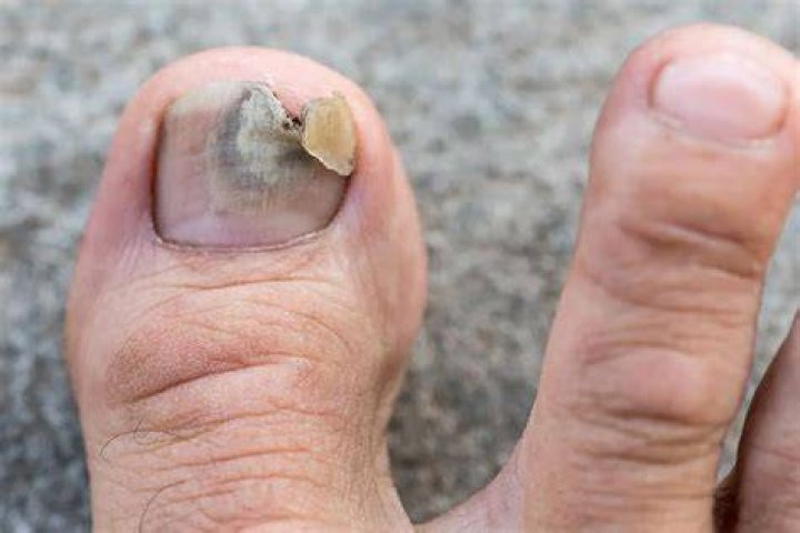 What happens to runners toenails?