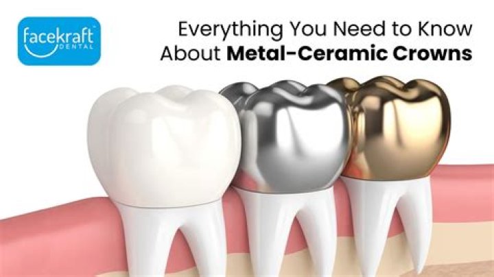 What is a metal crown dental?