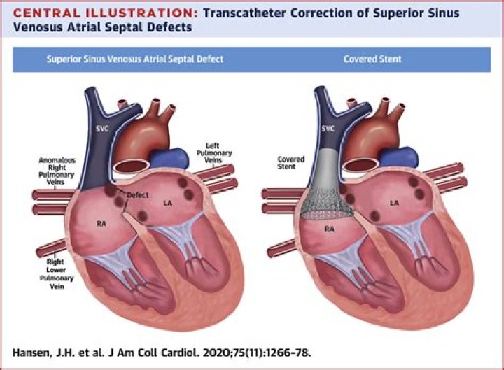 What is a sinus venosus atrial septal defect?