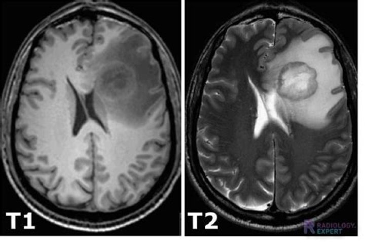 What is a t1 and t2 hyperintense lesion?