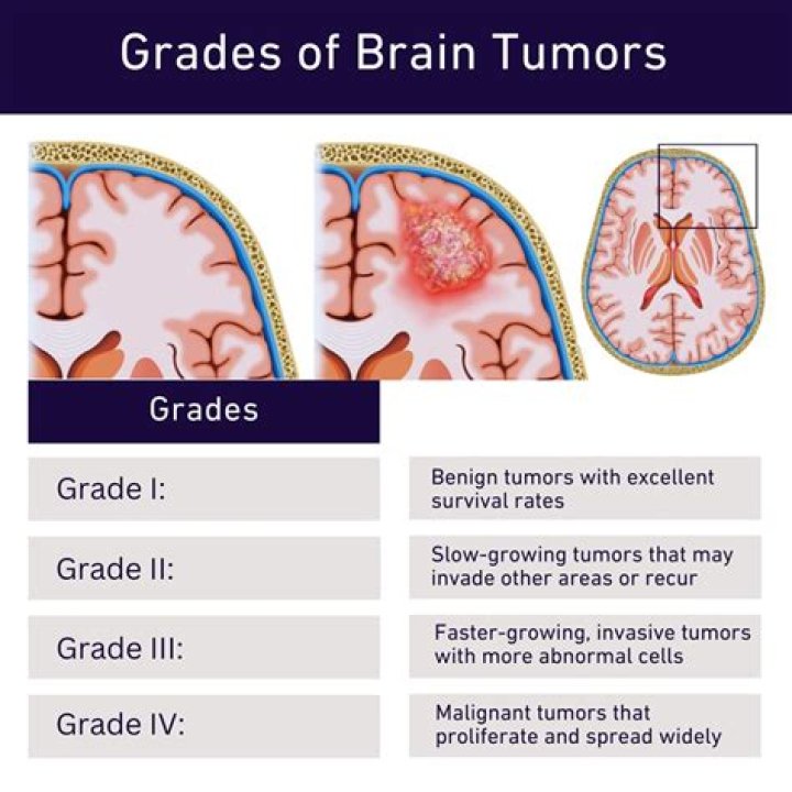 What is considered a fast growing brain tumor?