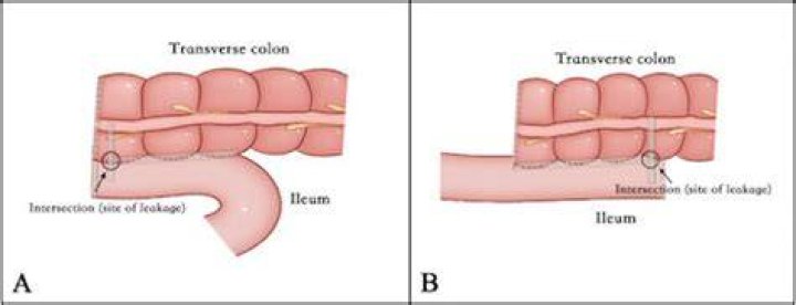 What is Isoperistaltic anastomosis?