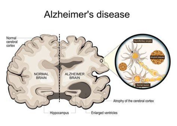 What is it called when Alzheimer's patients remember?