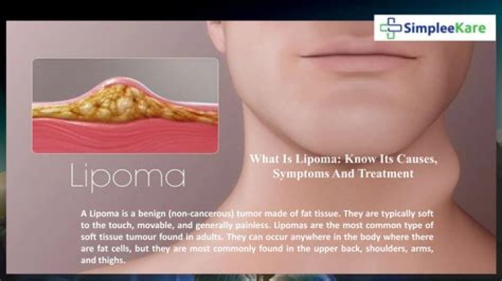 What is lipoma of the cord?