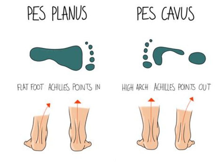 What is pes planus and Pes Cavus?