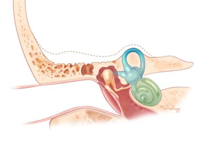 What is tegmen dehiscence?