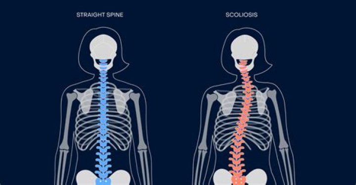 What is the best therapy for scoliosis?