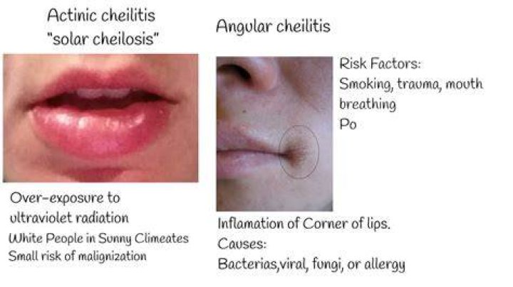 What is the meaning of Cheilosis?