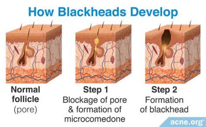 What is the medical term for a blackhead?
