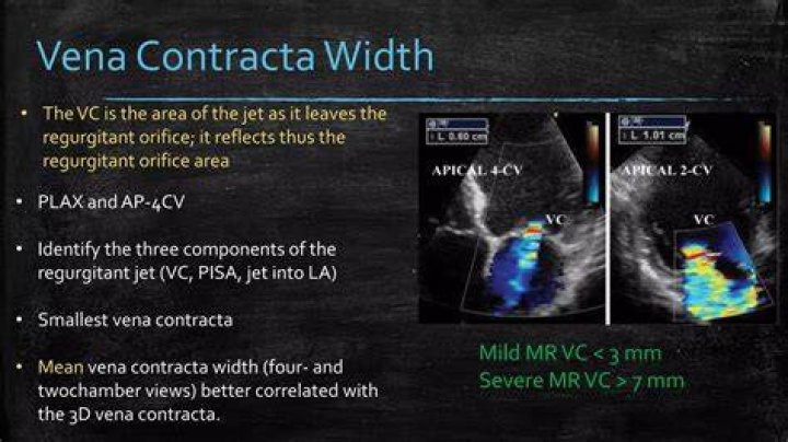 What is Vena Contracta width?