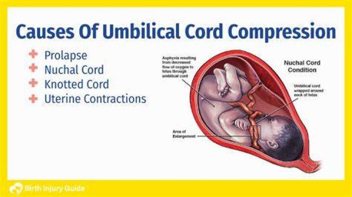 What percentage of babies die from umbilical cord strangulation?