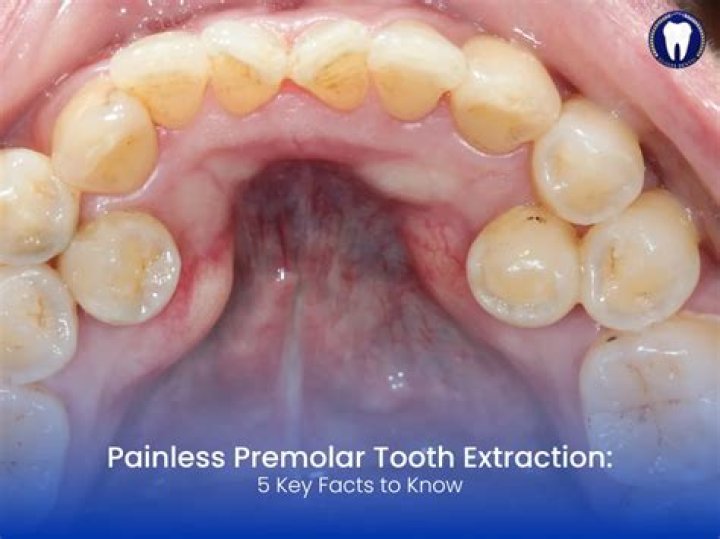 What premolars are extracted for ortho?