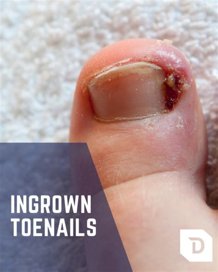 What should I do if my toddler has an ingrown toenail?