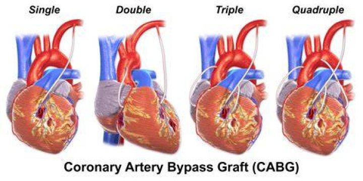 Where are the ends of the vein grafts attached to in the CABG?