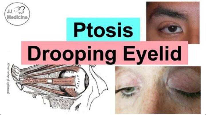 Which word means drooping or sagging of the eyelid?