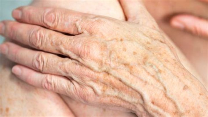 Why am I getting spots on my hands?