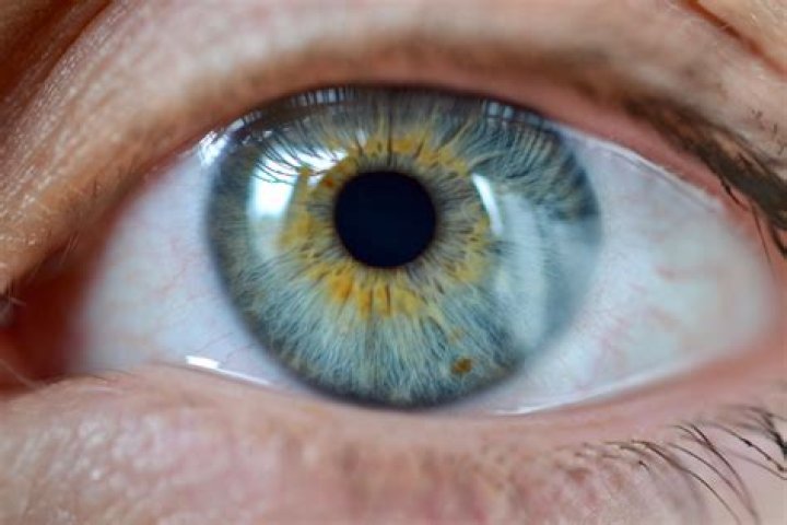Why do I have a yellow ring around my eye?
