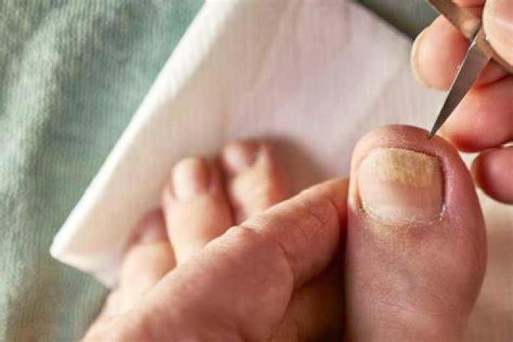 Why does it smell like cheese under my toenails?