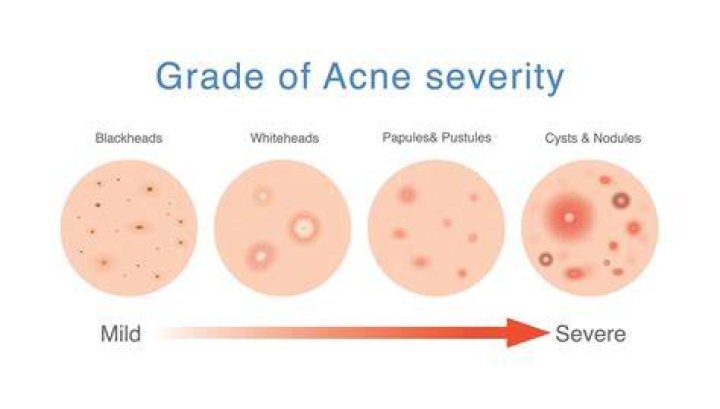 Why is cystic acne so bloody?