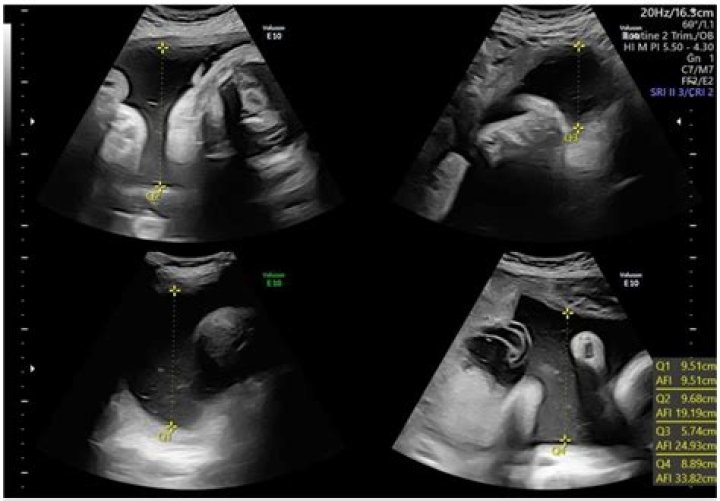 Why is my poop black at 36 weeks pregnant?